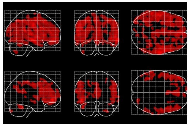 Forever young: Meditation might slow the age-related loss of gray matter in the brain