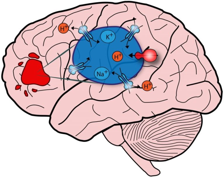 What autism can teach us about brain cancer: Both disorders involve faults in same protein