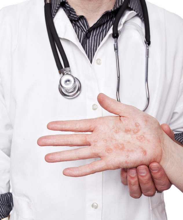 Hand washing focus in hospitals has led to rise in worker dermatitis