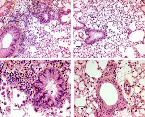 Severe asthma: Gallopamil confirmed as a therapeutic approach