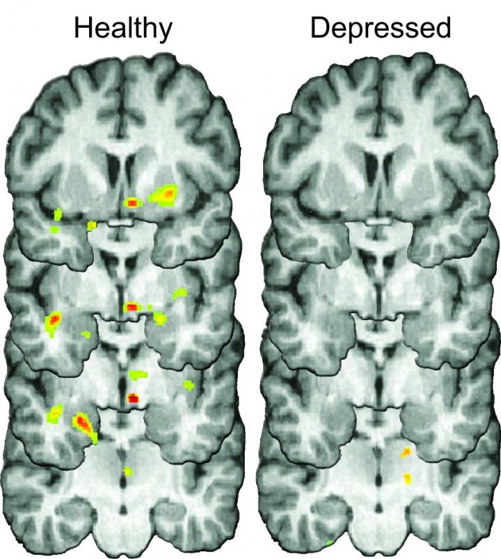 Shake it off? Not so easy for people with depression, new brain research suggests