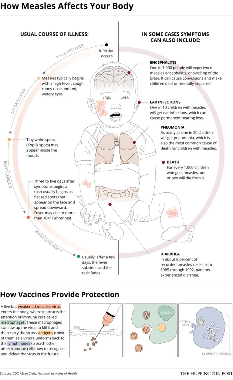 What Really Happens When You’re Infected With Measles