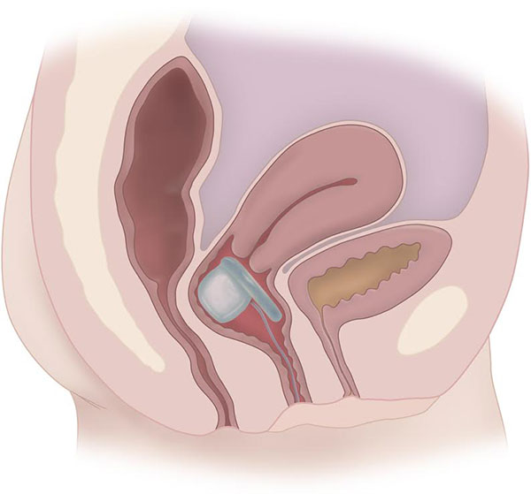 Pelvalon’s Eclipse Vaginal Insert for Fecal Incontinence FDA Approved