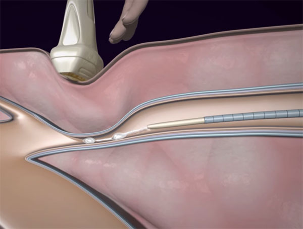 Sapheon VenaSeal Closure System for Varicose Veins Now FDA Approved (VIDEO)