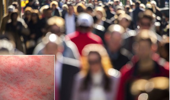 Measles Outbreak Linked To Disneyland Swells To More Than 100 Cases