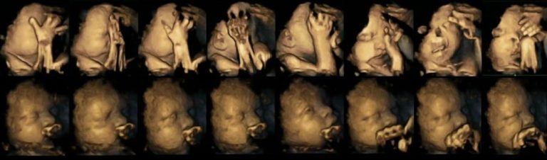 High-definition scans suggest effects of smoking may be seen in unborn babies