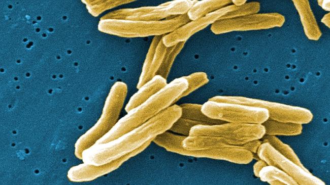 CONCERN: The latest case marks the third time TB has been confirmed in a Far North school