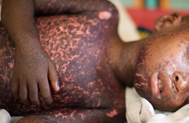 Ebola Could Cause Thousands More Deaths — By Ushering In Measles