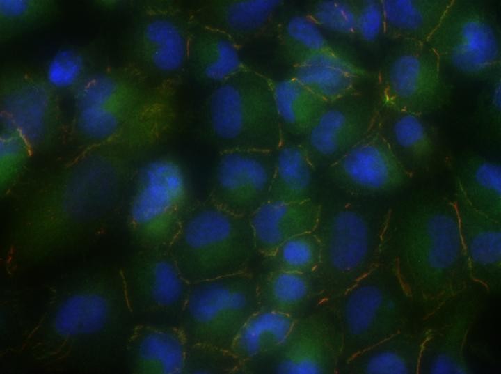 Inactive tumor suppressor gene discovered in lung cancer