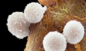 Leukaemia blood cells seen under a scanning electron micrograph. Leukaemia is the most common type of cancer diagnosed in children.