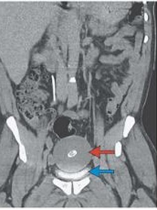 Green ink was used to highlight the different layers in the fat ball. Picture: New Englan