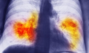 Chest x-ray showing lung cancer. In the 2000s, 18% of patients diagnosed with lung cancer in Austria survived – almost twice the rate in the UK.