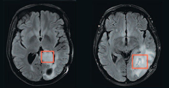 STUDY: Thinking Can Fuel The Growth Of Brain Tumors