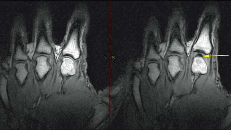 What actually happens when you crack your knuckles