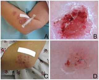 Skin lesions and fibers from Morgellons patients.