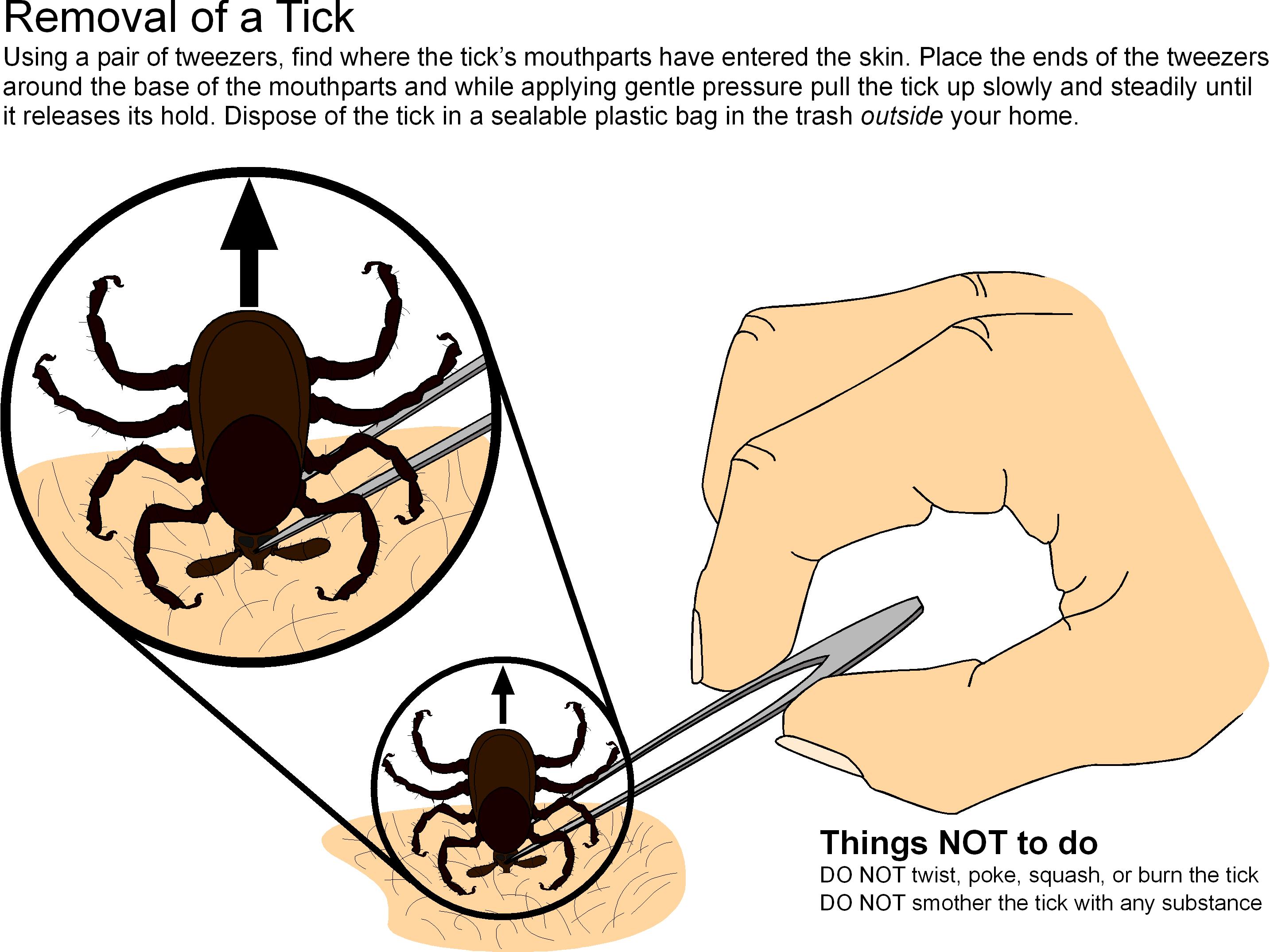 tick removal