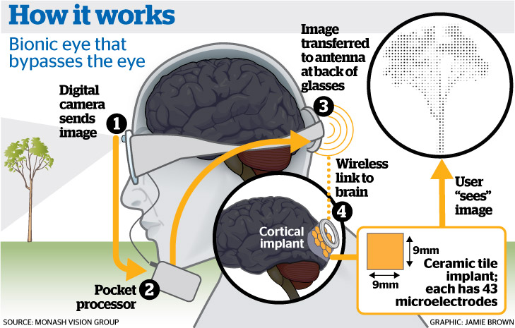 bionic eye