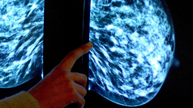 Breast cancer screening harming hundreds of women a year: Surgeon