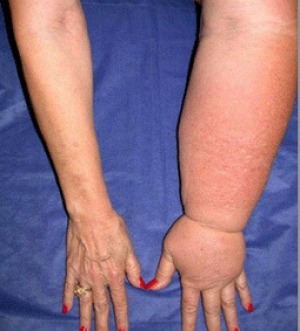 Symptoms of lymphoedema.