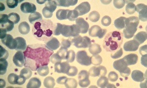 Neutrophils + monocyte