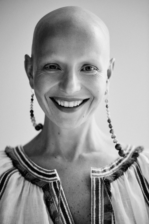 Women explain life after hair loss in uplifting photo series