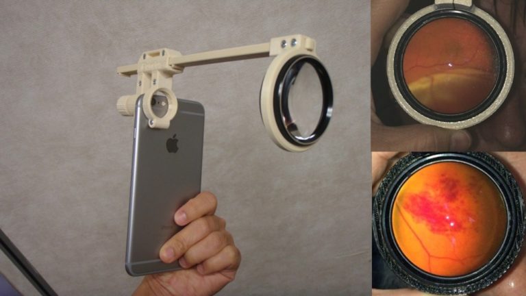 World’s First Open Source Smartphone Retinal Camera