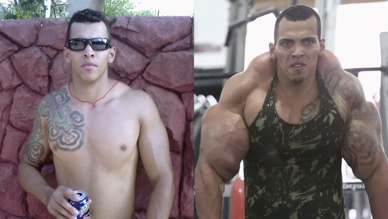 Real-life Hulk nearly forced to have arms amputated