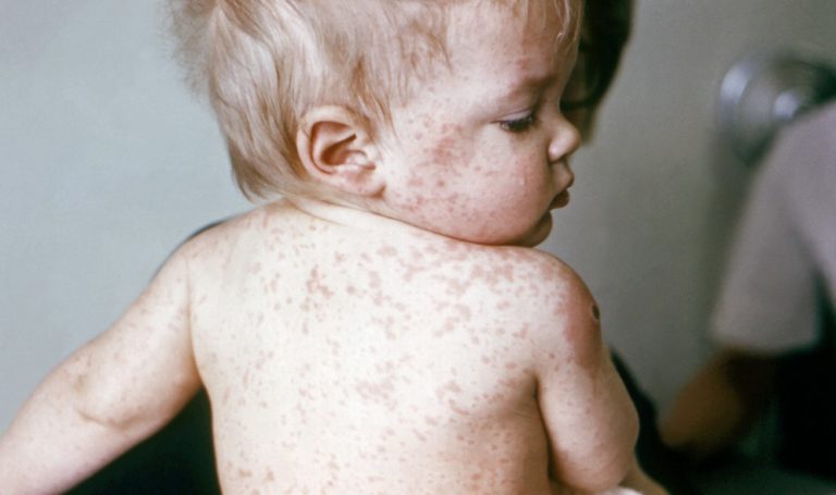 How The Measles Vaccine Could Prevent Other Serious Illnesses