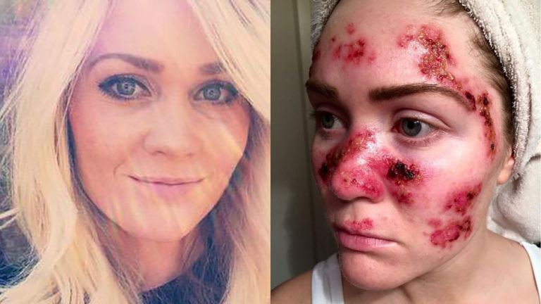 Frequent tanner shares graphic selfie of her skin cancer treatment