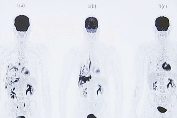 PET scans of Bradley Selmon's lungs