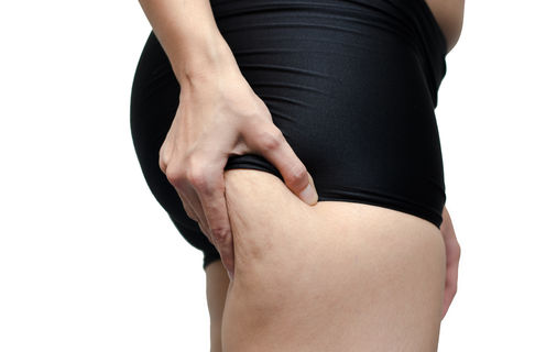 Health Check: what is cellulite?