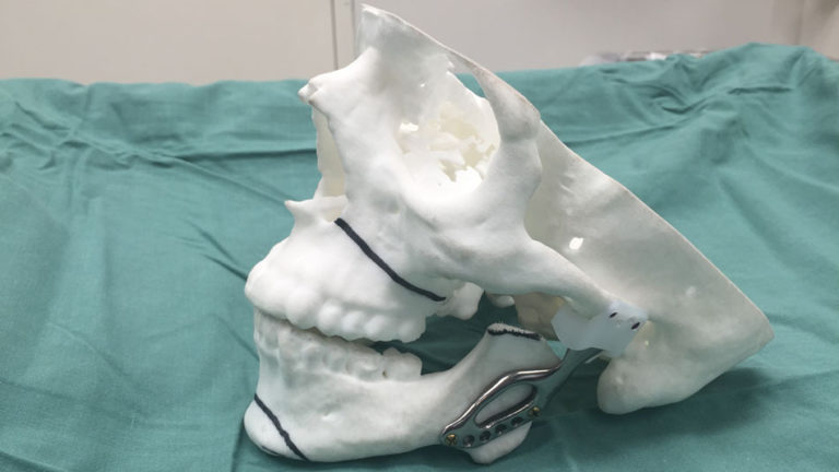 Aussie Iron Man: Patient receives a 3D-printed titanium jaw