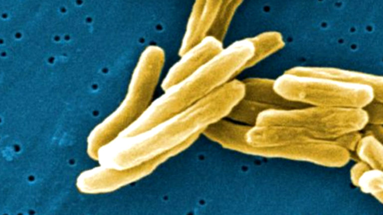 Hundreds In U.S. May Have Been Exposed To Rare Form Of Drug-Resistant Tuberculosis