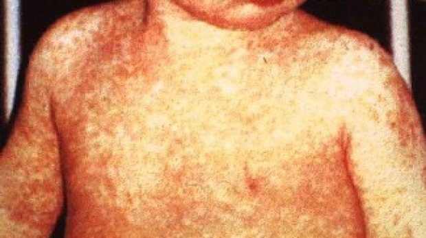 Measles alert in Brisbane’s west