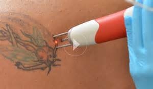 Tattoo-removal lasers seized after skin burns