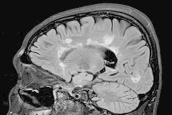 MS breakthrough: Technology developed to assist in brain lesion detection