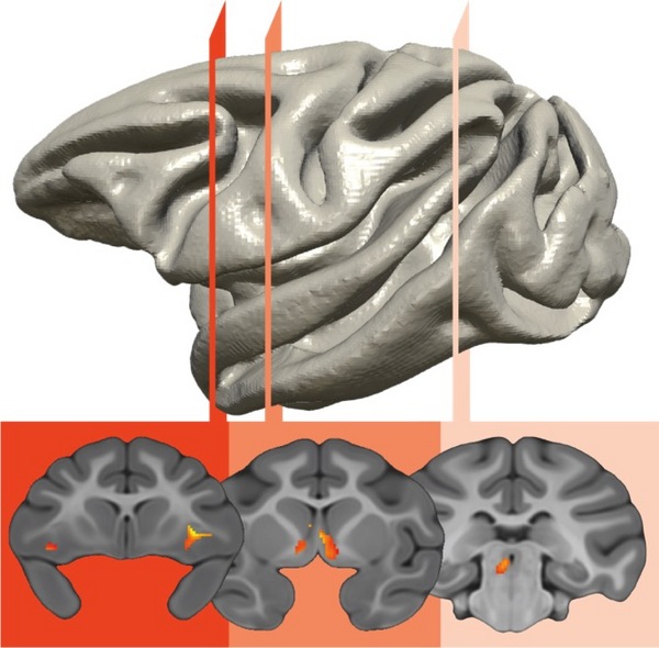 Over-activity in the prefrontal-limbic-midbrain circuit (seen above) is responsible for the genetic transfer of an anxious temperament. Illustration courtesy of Kalin Lab.