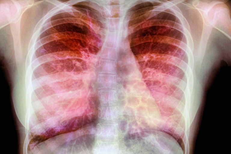 Gene therapy works in cystic fibrosis for the first time