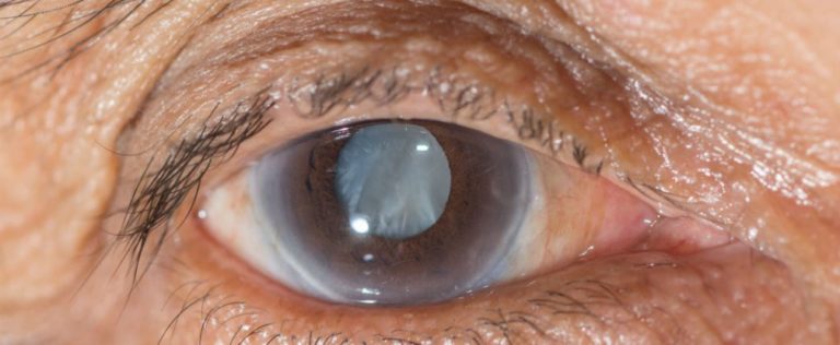 Scientists have developed an eye drop that can dissolve cataracts