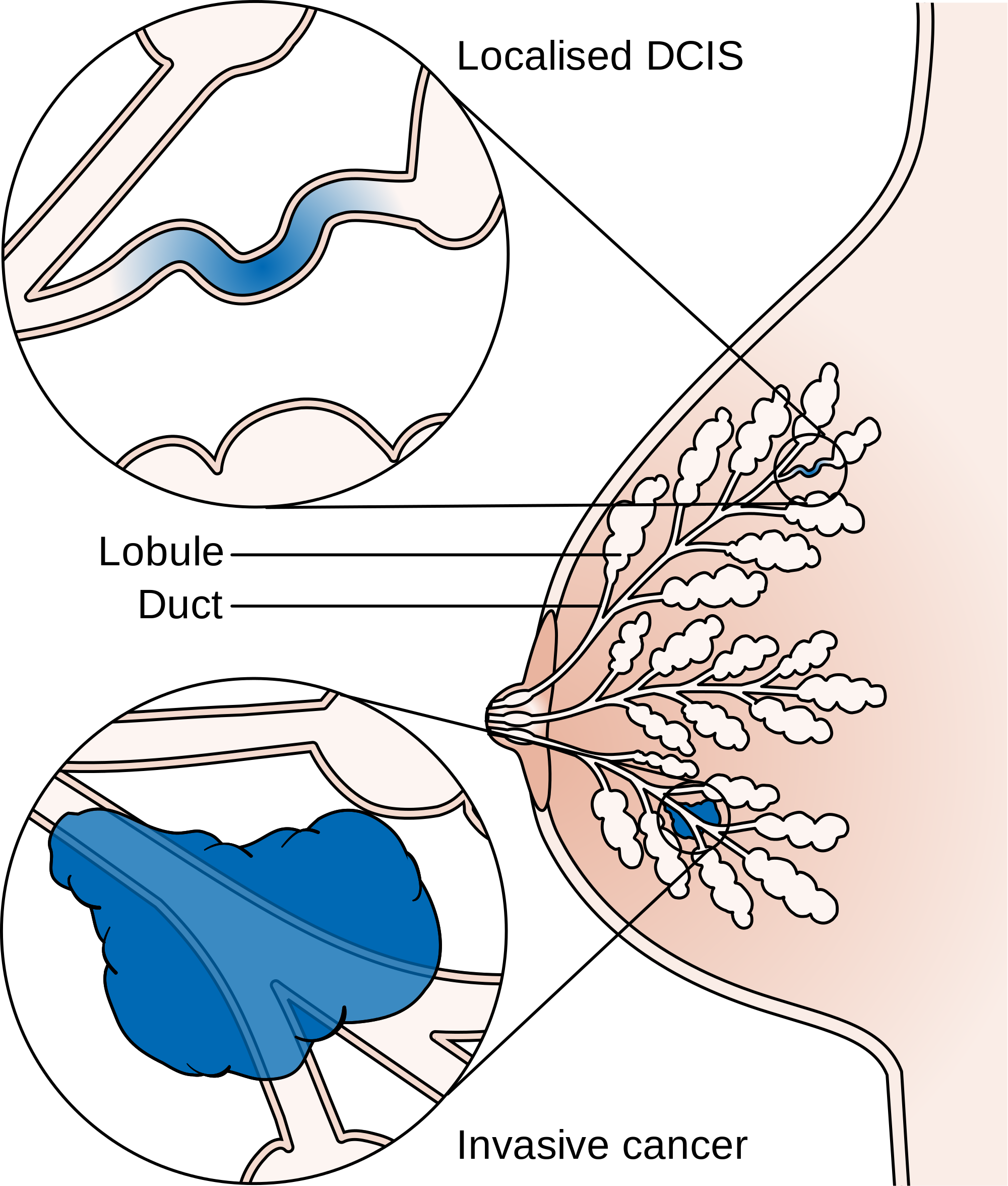 breast cancer_dcis 3