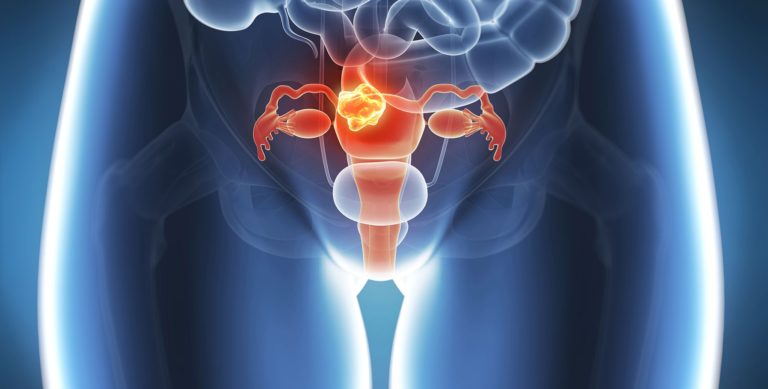 Ovarian Cancer Survival Rates Are Actually Much Higher Than We Thought