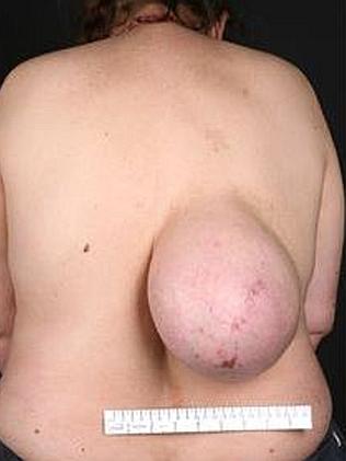 The lump has been growing for 10 years. Picture: bmj.com