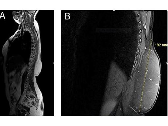 MRI ... the woman said the mass on her mid-lower back grew significantly over the last th