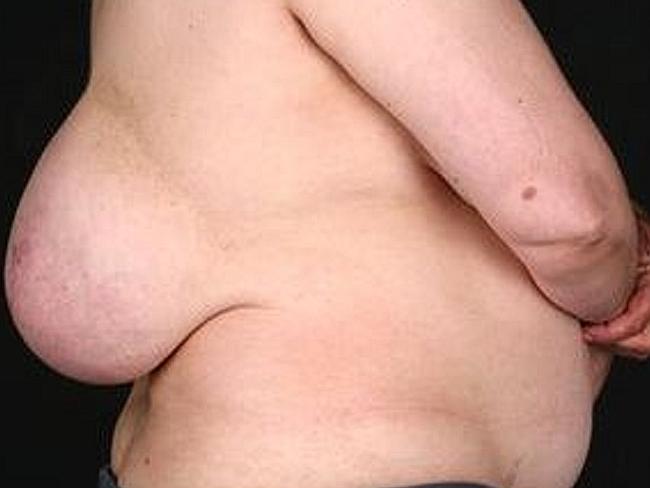 Lipoma ... doctors said the tumour is a non-cancerous growth made up of fat cells. Pictur