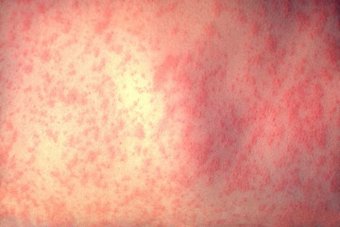 More measles cases traced to University of Queensland