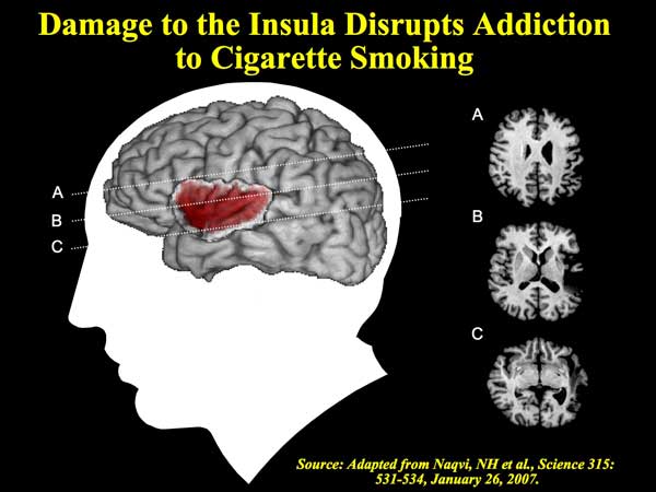 brain_Insular cortex 2