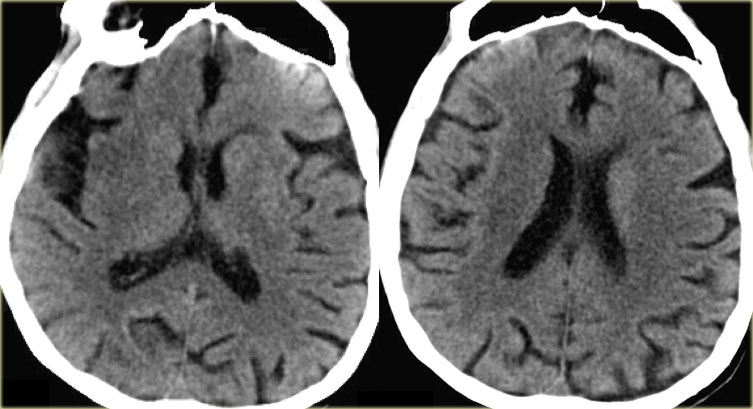 Scientists Studying Stroke-Related Brain Damage Just Made A Breakthrough Discovery About The Source Of Addiction