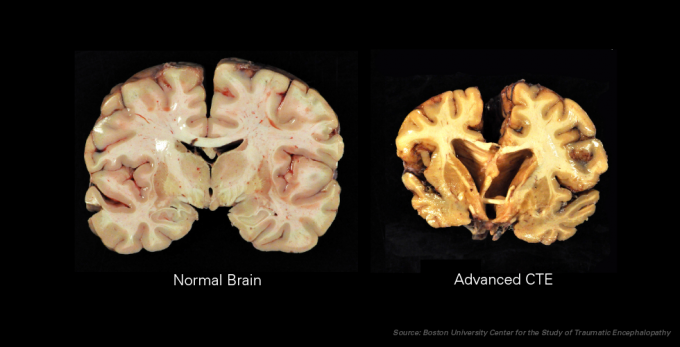 This brain scan shows the severe damage associated with CTE, compared to a healthy brain.