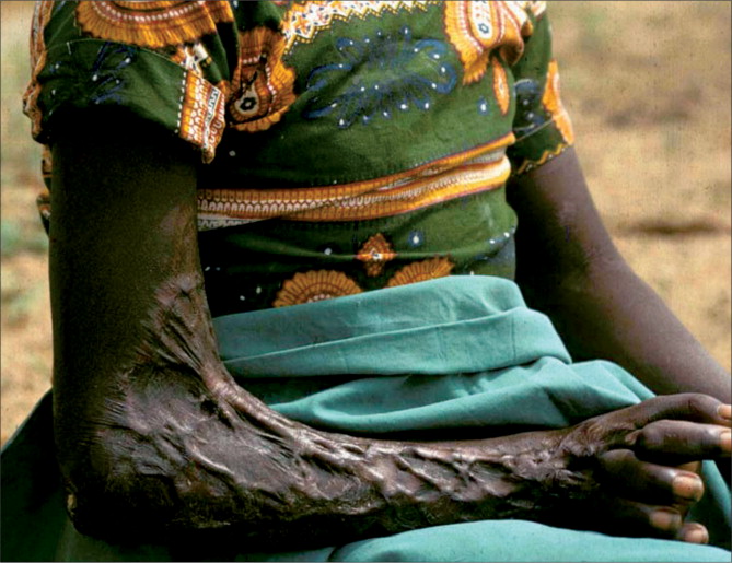 Above, a young Nigerian girl with lasting scars and debilitating contractures following a bite from a black-necked spitting cobra (Image Credit: The Lancet)