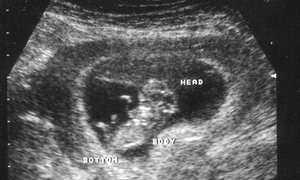 Ultrasound scan of a foetus in the womb